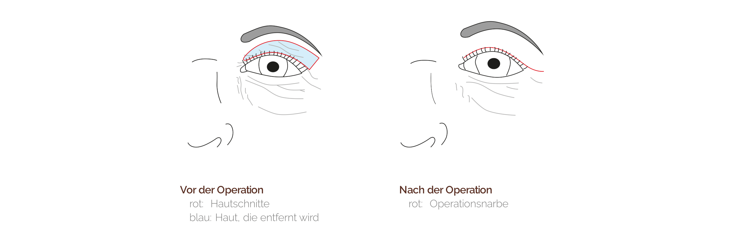 oberlidblepharoplastik WP 1